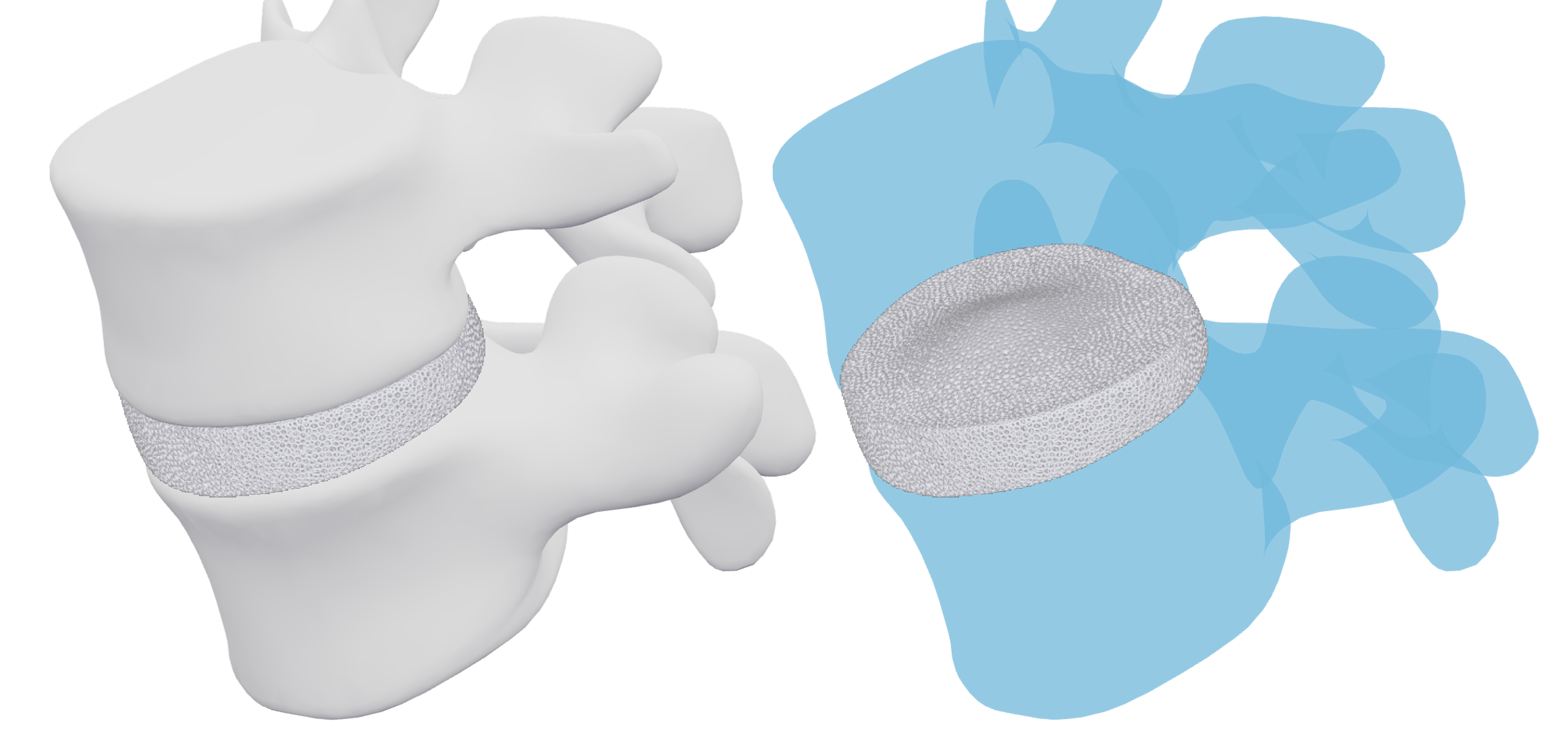 Demo of lumbar implant